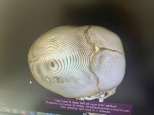 Хирургическое исправление врожденного дефекта костей черепа