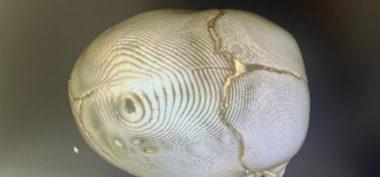 Хирургическое исправление врожденного дефекта костей черепа